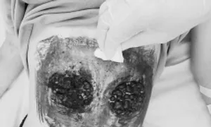 Nguy kịch sau khi dùng giác hơi chữa ung thư máu